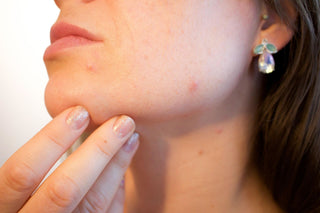 Does Sleeping on Your Face Cause Acne?